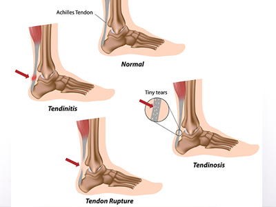 North Miami Beach Achilles Tendonitis