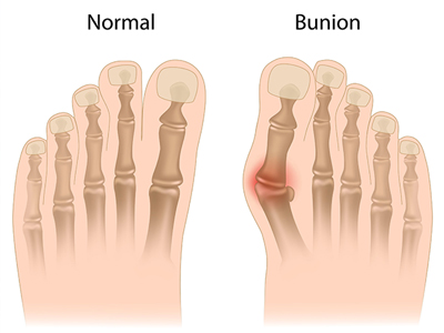 Bunion Treatment North Miami Beach