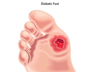 North Miami Beach Diabetic Foot Care