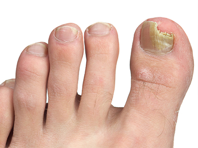 Fungal Nails Treatment in North Miami Beach