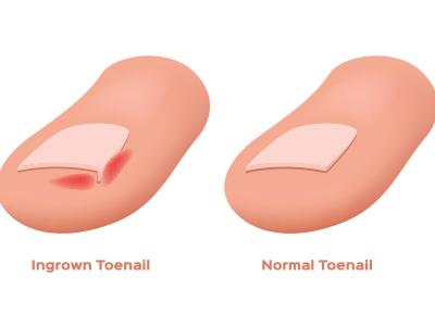 Ingrown Toenails Treatment 33162